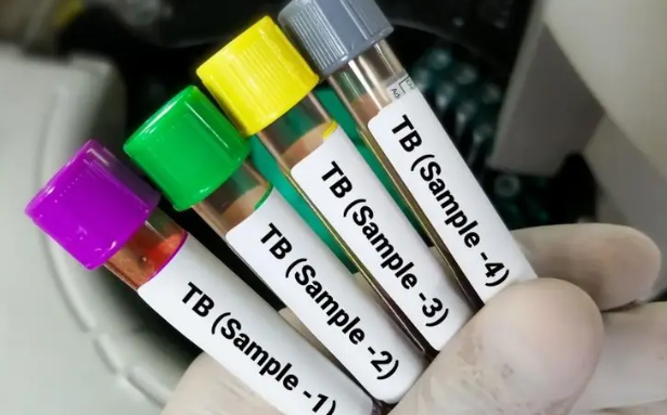 Tamil Nadu Becomes First State to Use Predictive Model to Reduce TB Deaths.